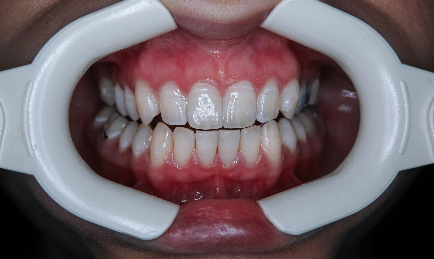 Nástroje pripravené na dentálnu hygienu